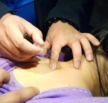 针灸 穴位埋线疗法