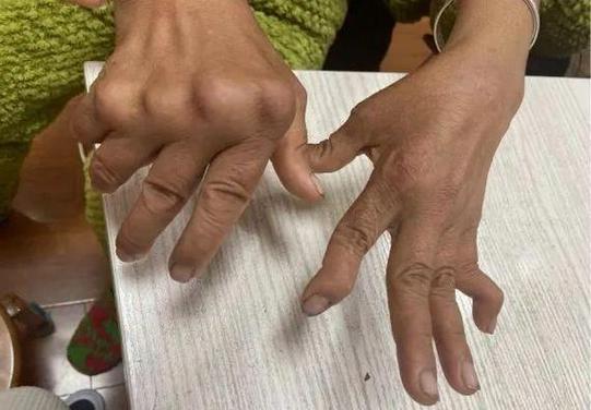 类风湿怀孕能吃乐松吗