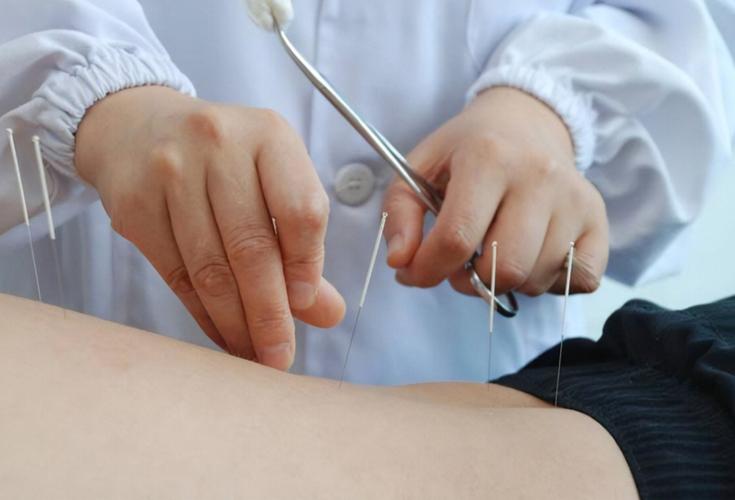 眩晕症针灸哪些穴位