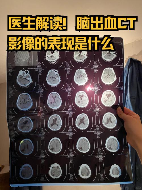 脑梗后脑子又有新出血