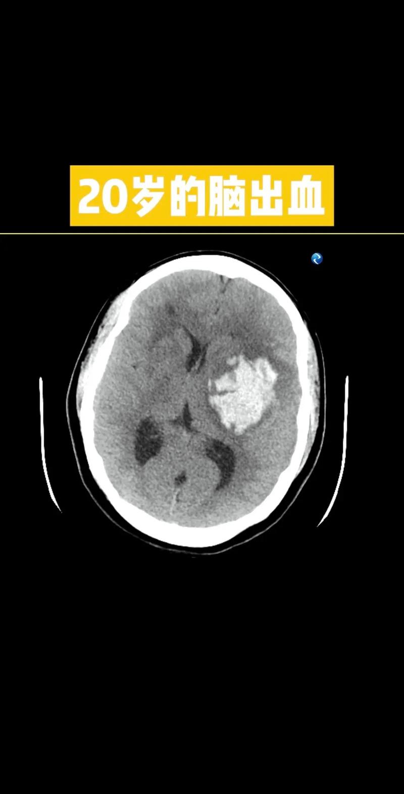 脑梗后脑子又有新出血