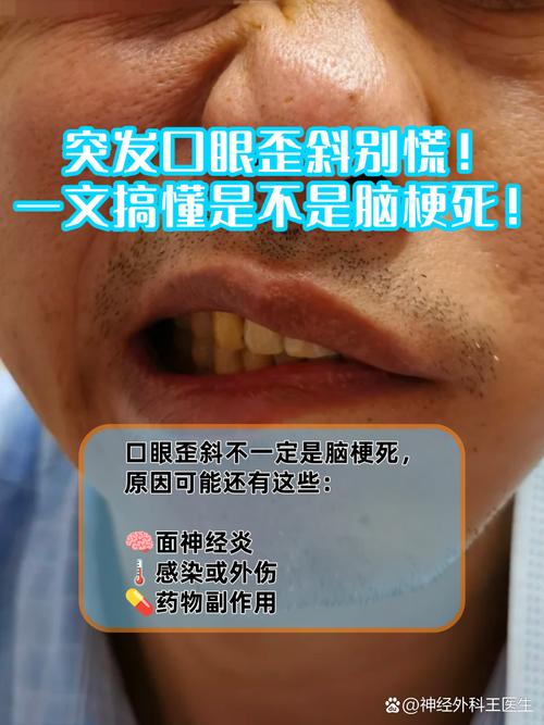 脑梗口眼歪斜能恢复吗