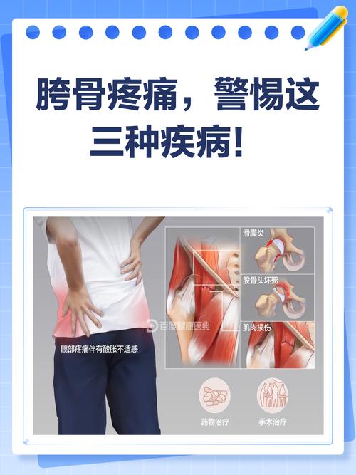 风湿胯骨疼是怎么回事