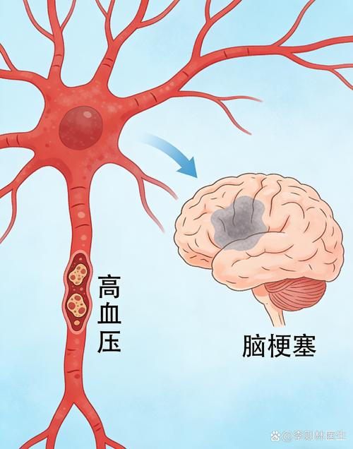 高血压引起脑梗的机制