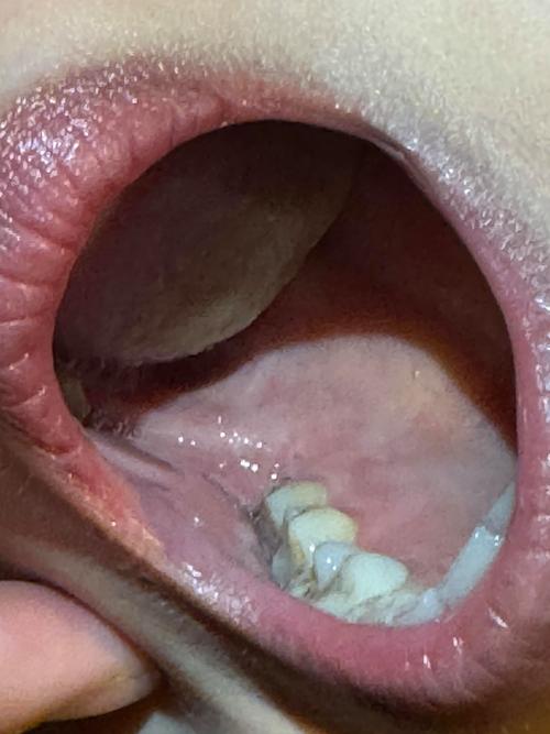 类风湿患者会口腔溃疡