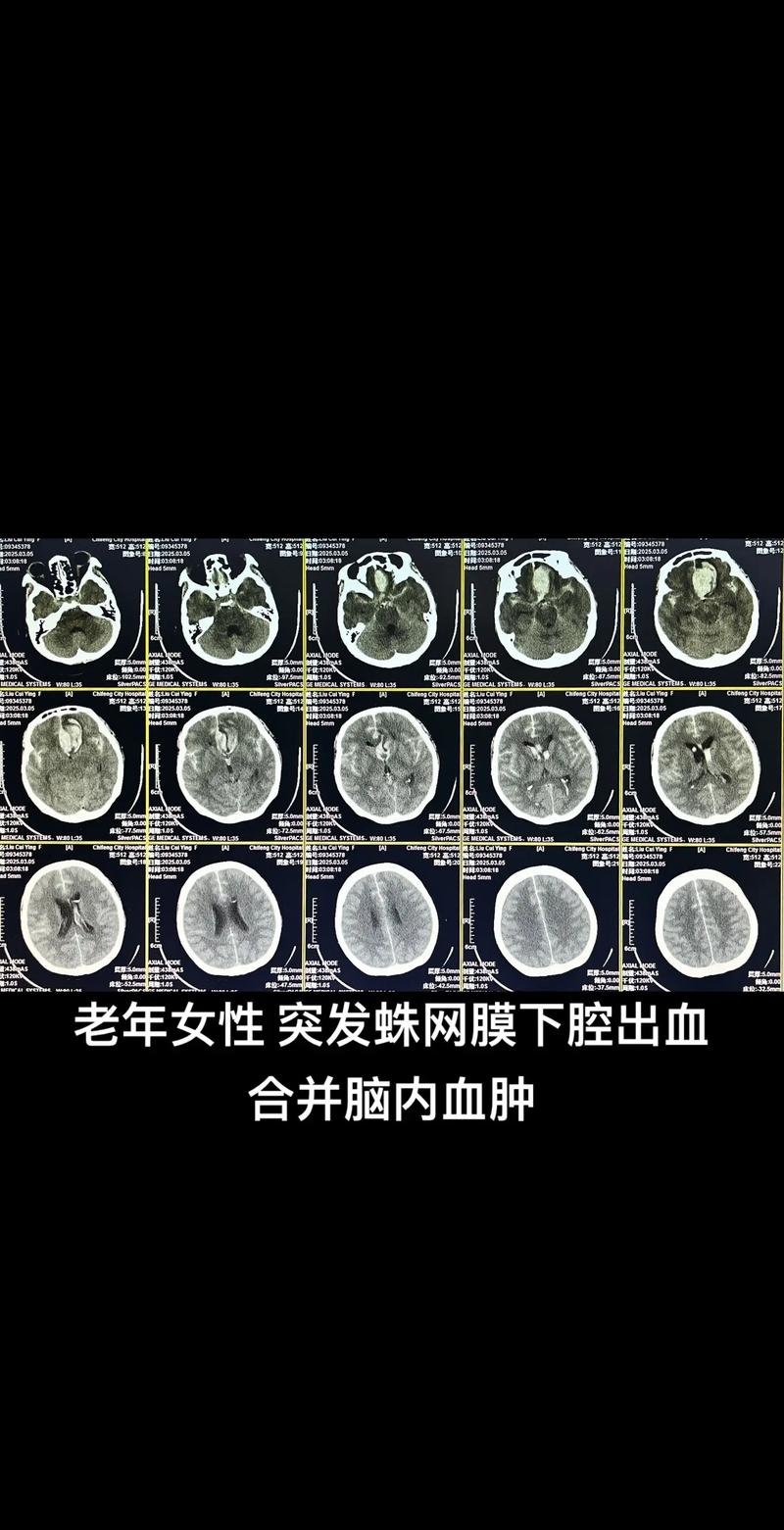 脑动脉血管瘤术 脑梗