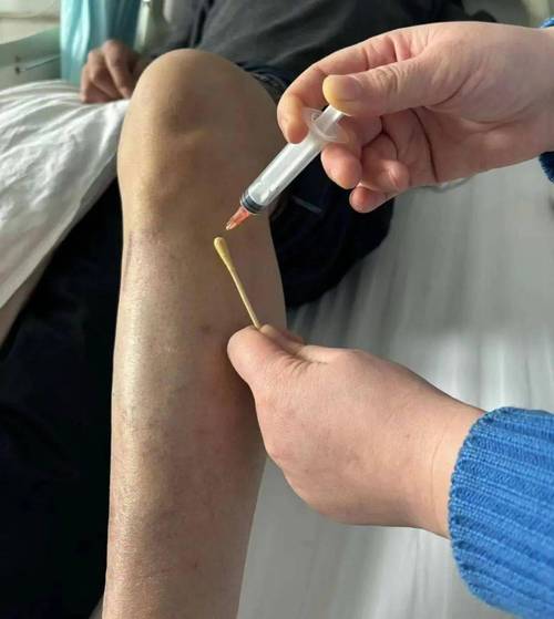 穴位注射与肌注异同