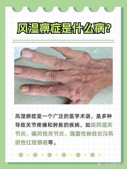 西医有没有风湿这个词