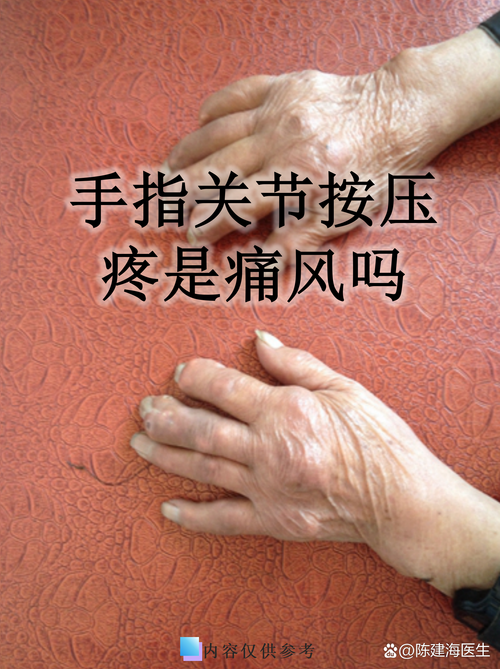 手指类风湿不能吃什么