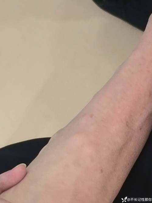 皮下风湿结节怎么治疗