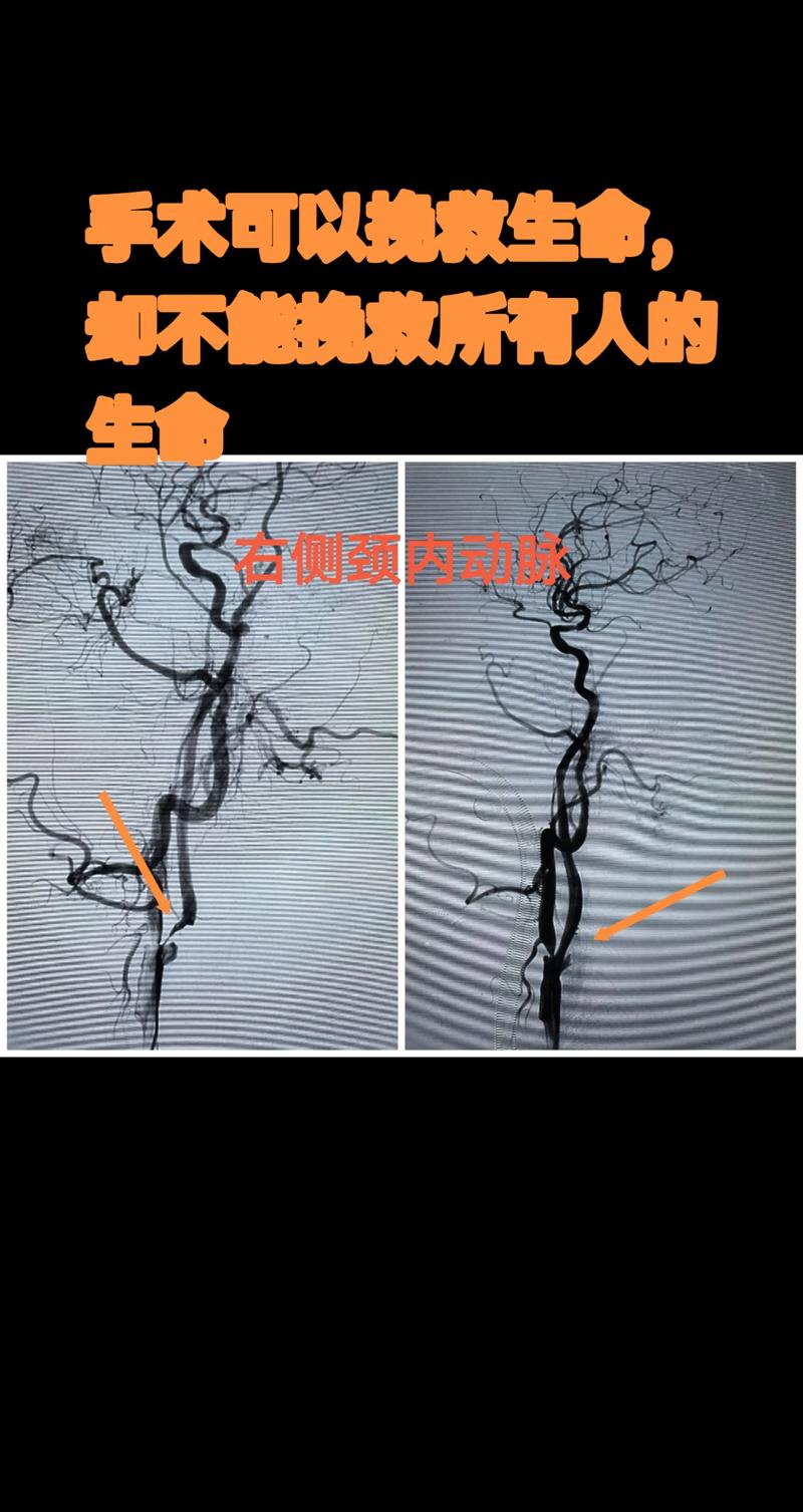脑梗什么情况下要手术