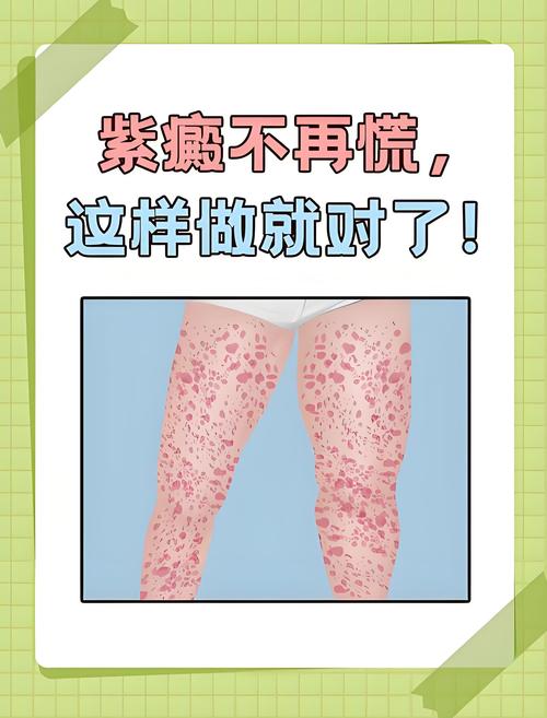 风湿性血小板减少症状