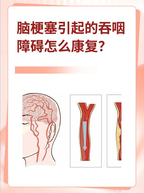 脑梗咽不下东西怎么办