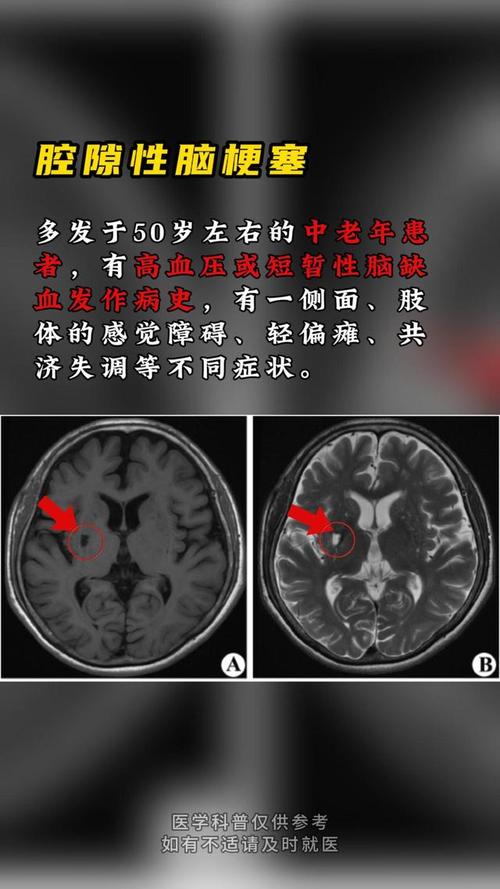 腔隙性脑梗怎么形成的