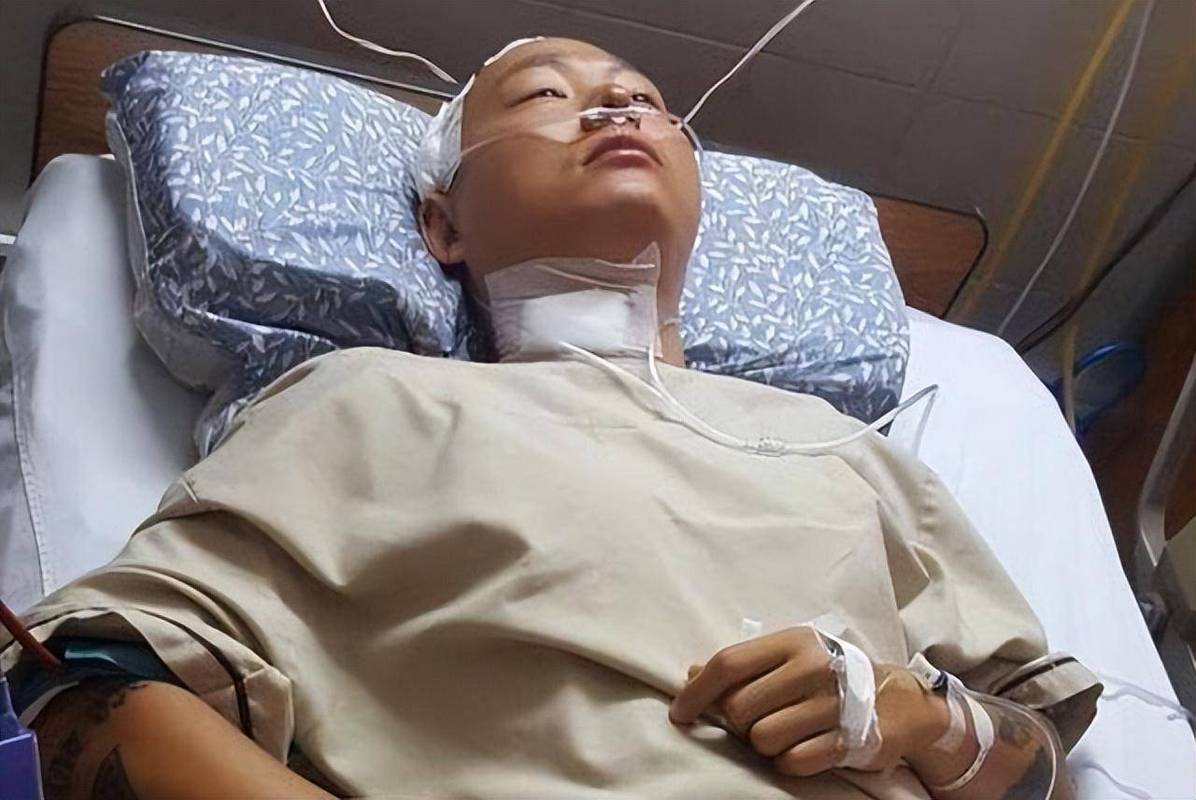 大面积脑梗引起脑水肿