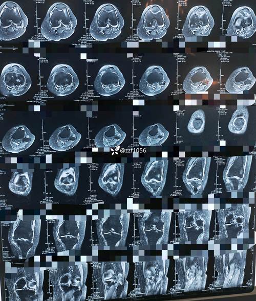 核磁共振能检查类风湿