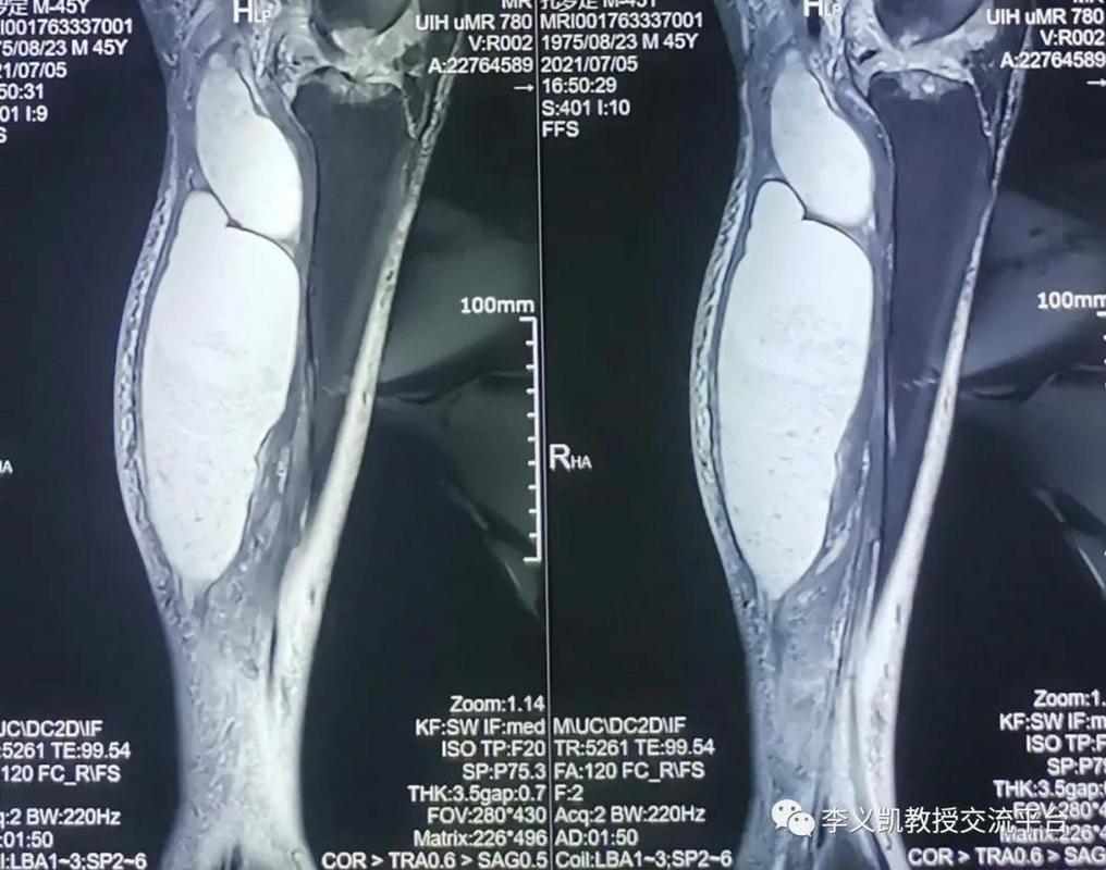 核磁共振能检查类风湿