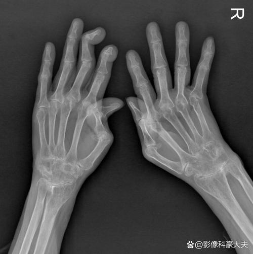 核磁共振能检查类风湿