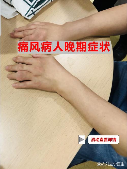 严重风湿导致左瘫右痪