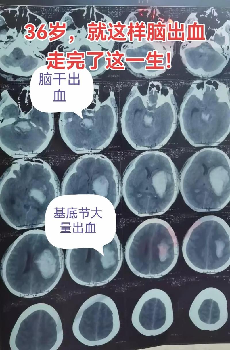 脑梗和脑出血同时出现
