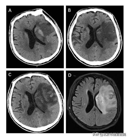 头颅ct能查出脑梗吗