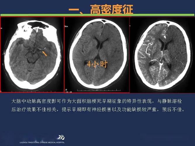 头颅ct能查出脑梗吗