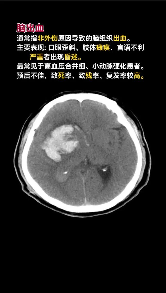 脑梗和脑出血症状区别