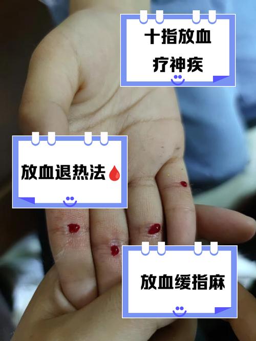 小手指末节穴位放血