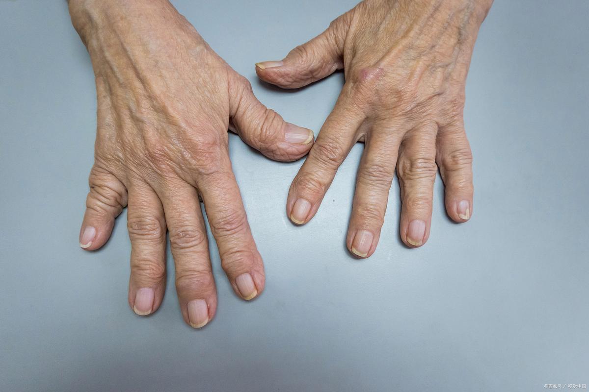 哈尔滨医大二院类风湿