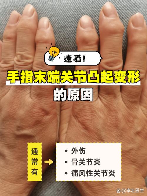 手指风湿变形怎么治疗