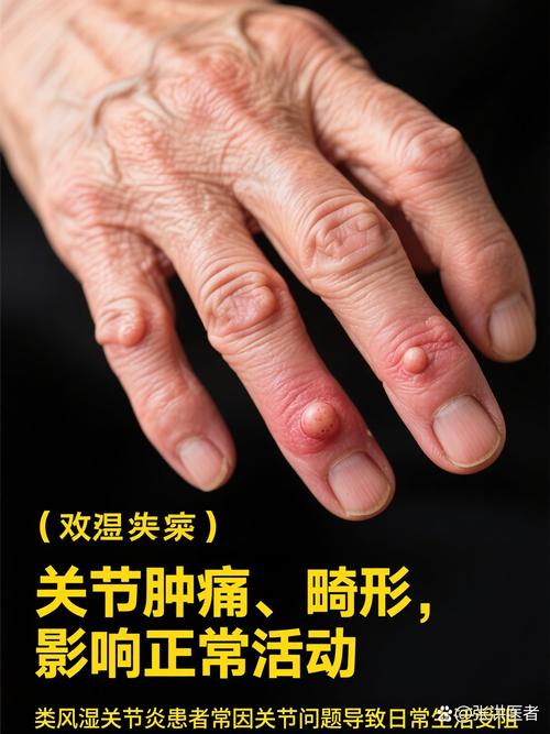 全国治类风湿医院排名