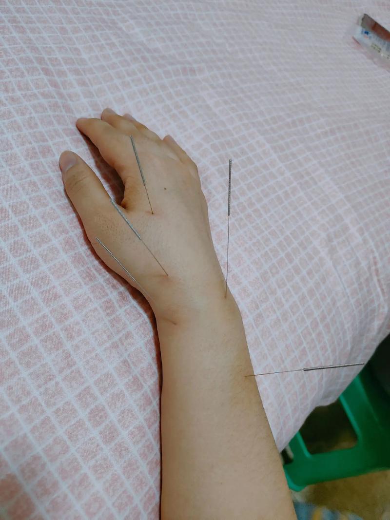 手腕挫伤的针灸穴位