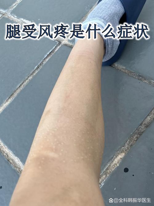受凉后腿麻木是风湿吗