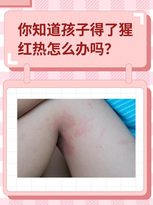 儿童血风湿有什么症状