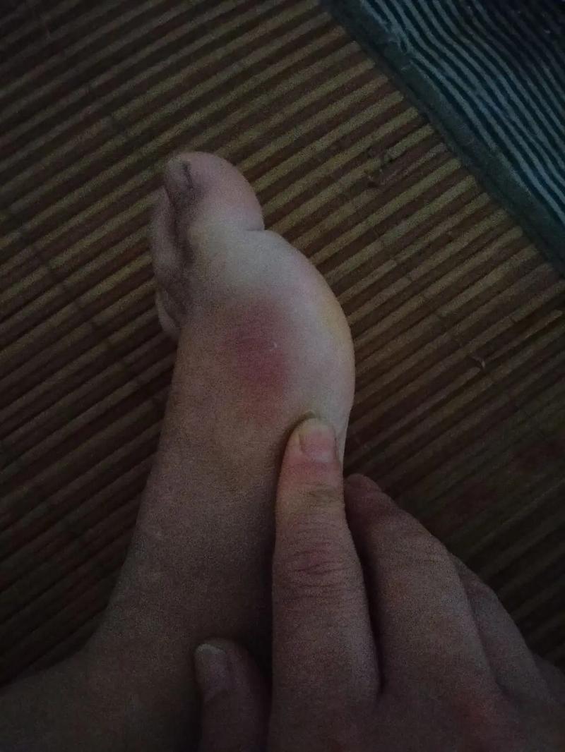 脑梗脚肿怎么快速消肿