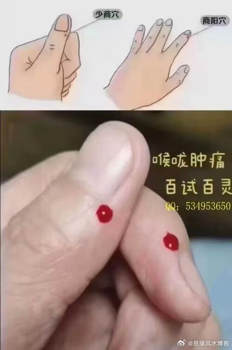 放血疗法的穴位视频