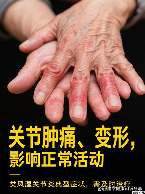 为什么类风湿对称发作