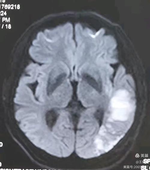脑部核磁共振脑梗图片