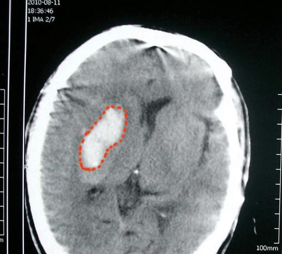 脑部核磁共振脑梗图片