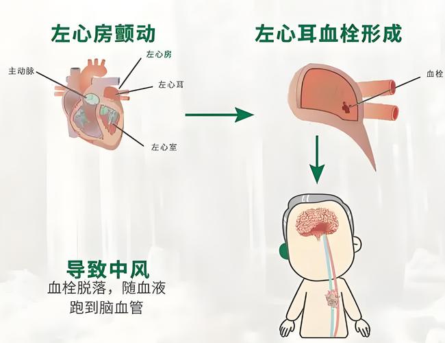 房颤引起脑梗能恢复吗