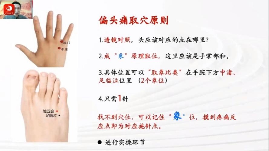 头痛的针灸治疗穴位