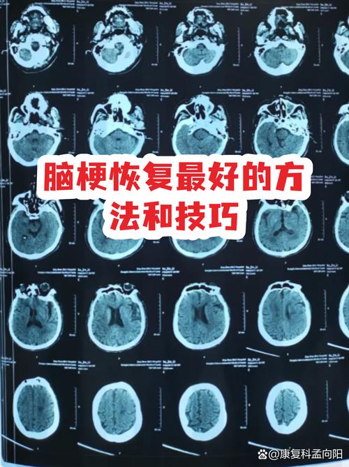 脑梗流口水可以恢复吗