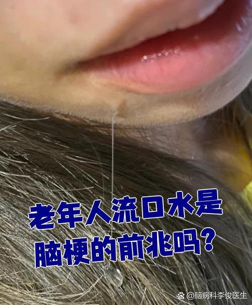 脑梗流口水可以恢复吗