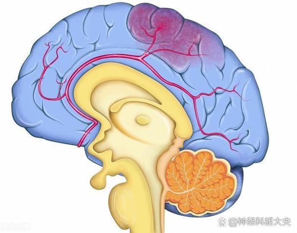 进展性脑梗不能阻止吗