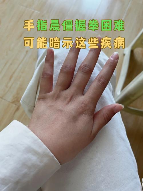产后风湿手指肿胀晨僵