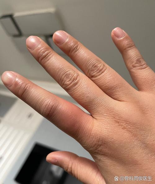 产后风湿手指肿胀晨僵