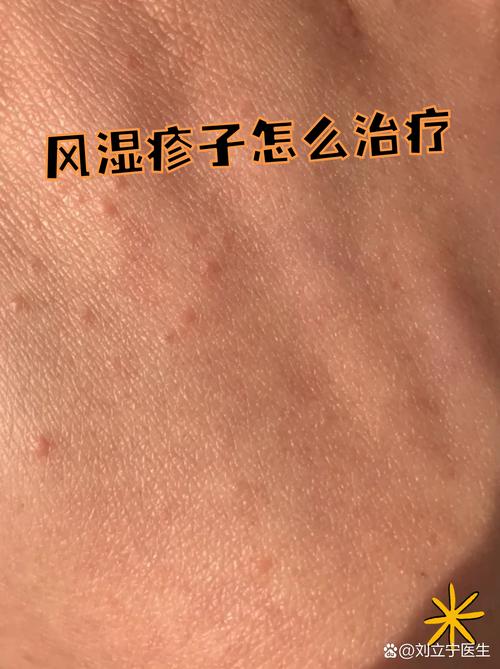 身上起了风湿疙瘩咋办