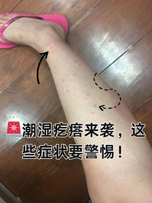 身上起了风湿疙瘩咋办