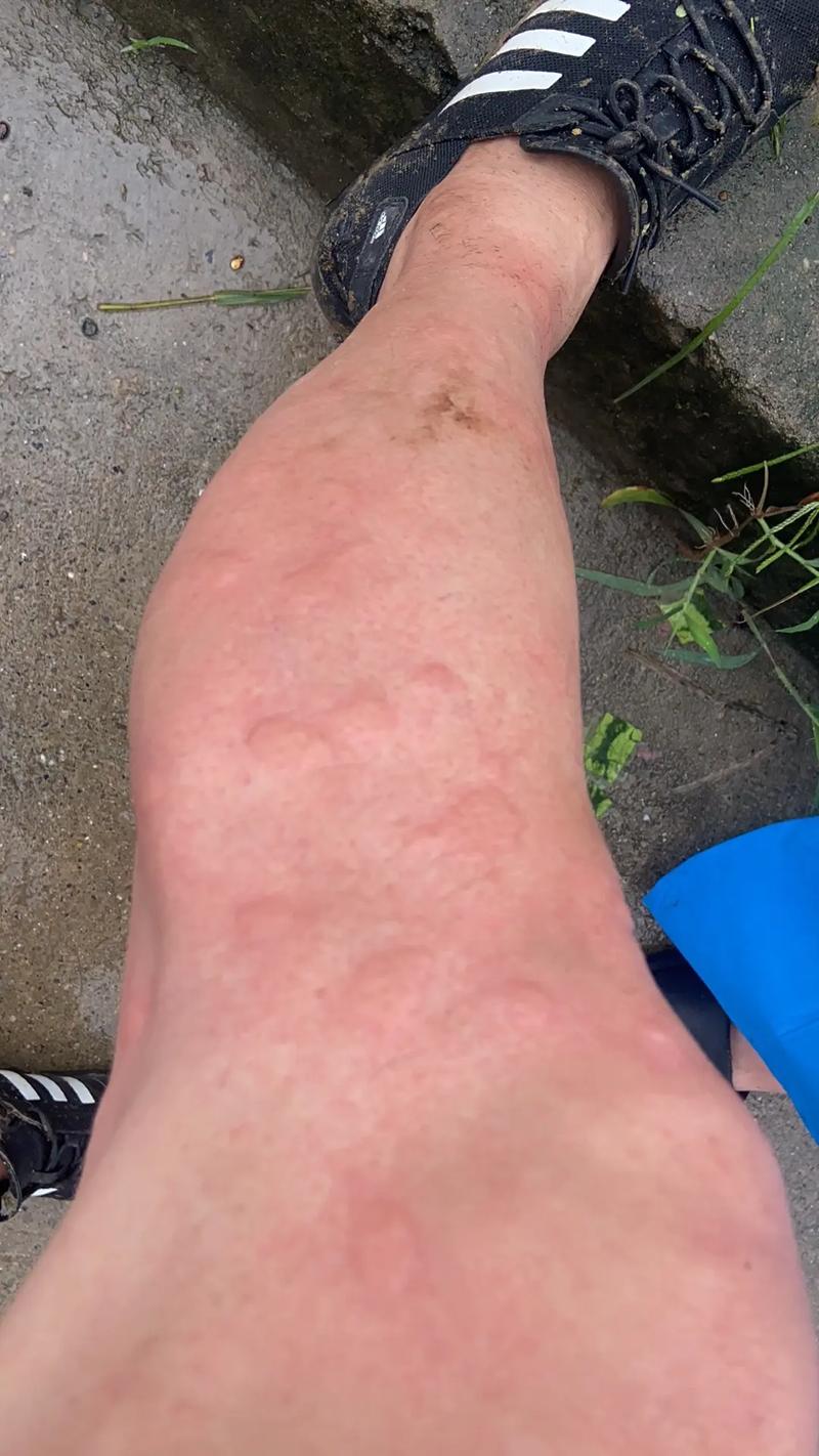 身上起了风湿疙瘩咋办