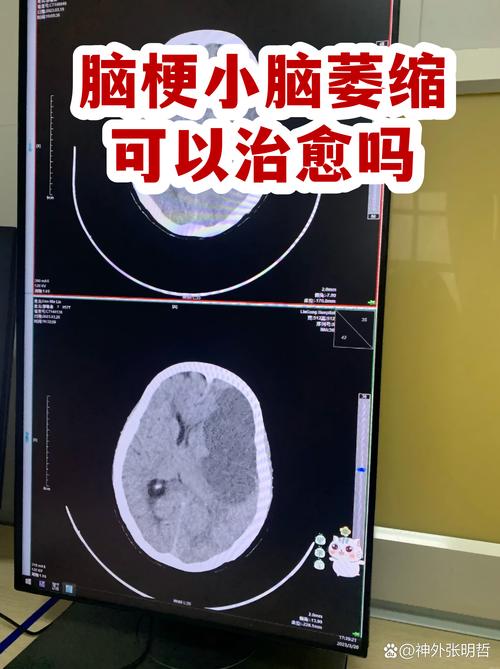 脑梗后多久可以坐飞机